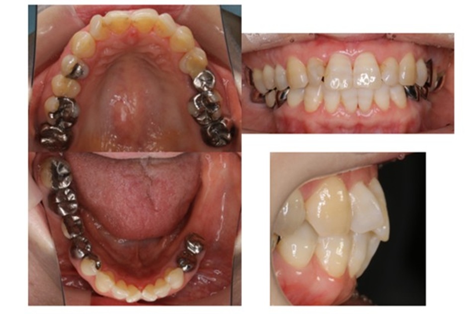 顎関節症、歯列不正。